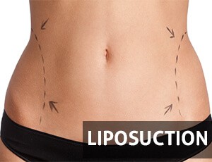 homepage_rows-16-en-liposuction.jpg